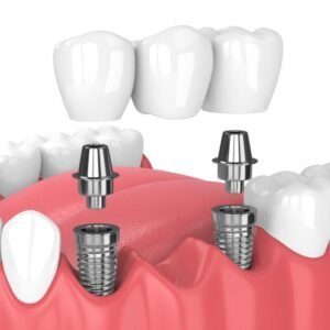 Representación de implantes dentales.